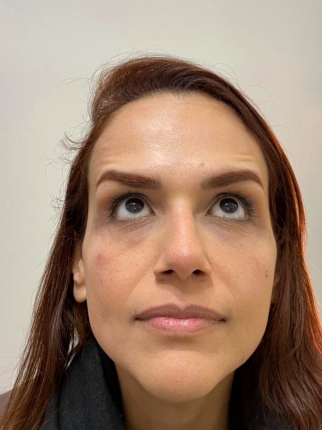 Testa suavizada após aplicação de toxina botulínica
